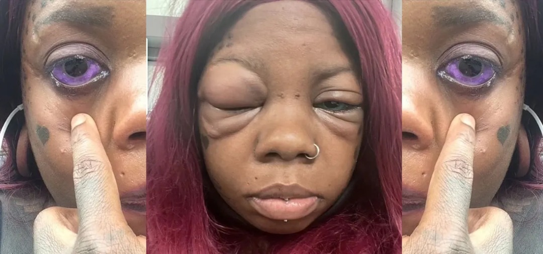 Mother Of Five Going Blind After Tattooing Her Eyeball Purple Ghanamma