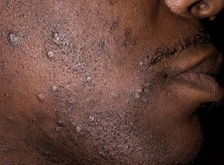 what-causes-pimples-after-shaving-beards-and-how-you-can-prevent-it