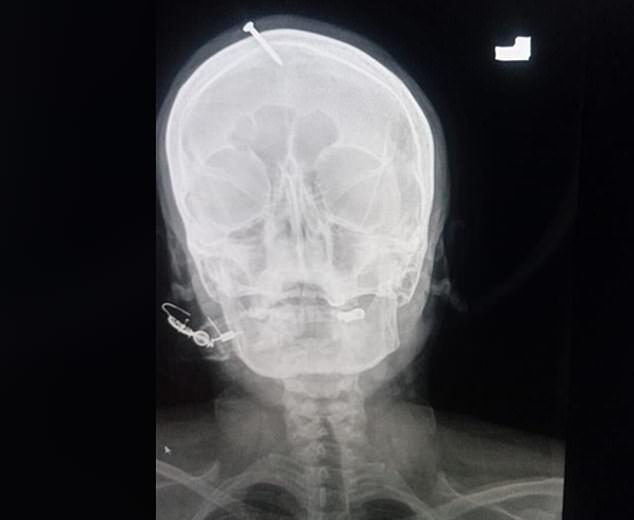 The pregnant woman arrived at the Lady Reading Hospital in the city of Peshawar with the two-inch nail pierced into the top of her forehead. Pictured: X-ray of the nail in the woman's head