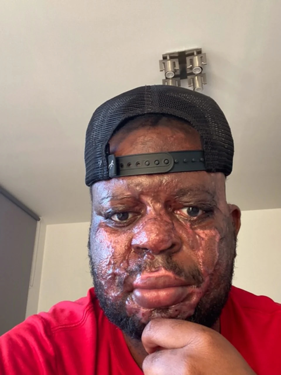 Kelvin Pogo suffered extensive burns to his face and body (Kelvin Pogo)