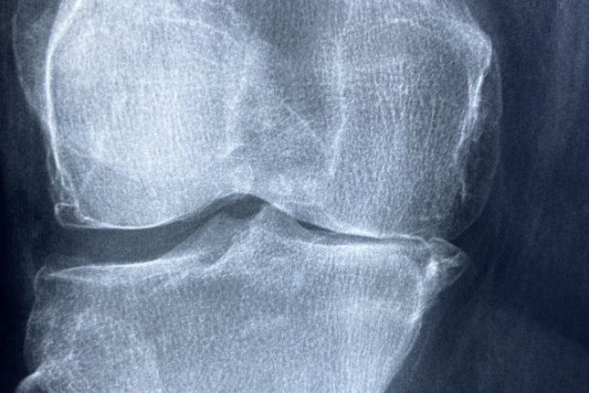 Knee replacement surgery for people over 80 may be safer than expected