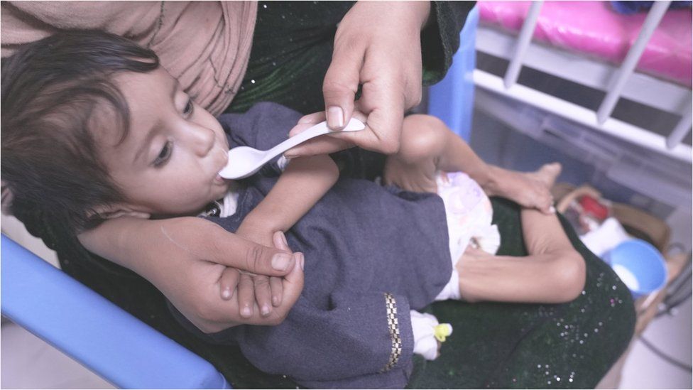 A small, emaciated child is fed by a spoon