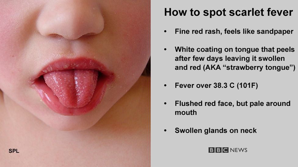 Symptoms of scarlet fever