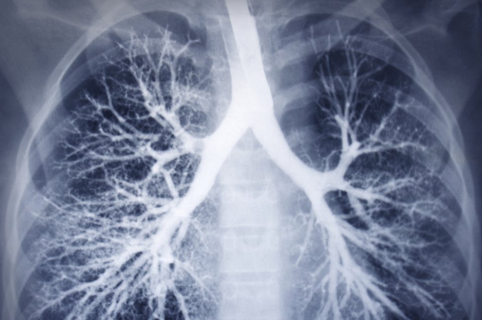 Simple screening for COPD could help millions globally, study finds