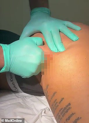 Jemmawas left in agony after suffering an infection that left her with 'severe' hip pain after she had fillers administered by a practitioner who isn't medically trained