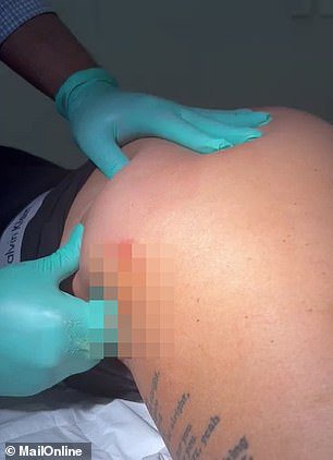 She had to have the filler removed by a qualified doctor (pictured)