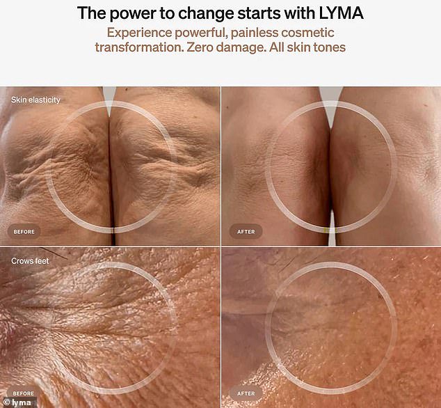 The LYMA Laser supports your skin's long term health and its appearance, gradually smoothing away even deep-set wrinkles