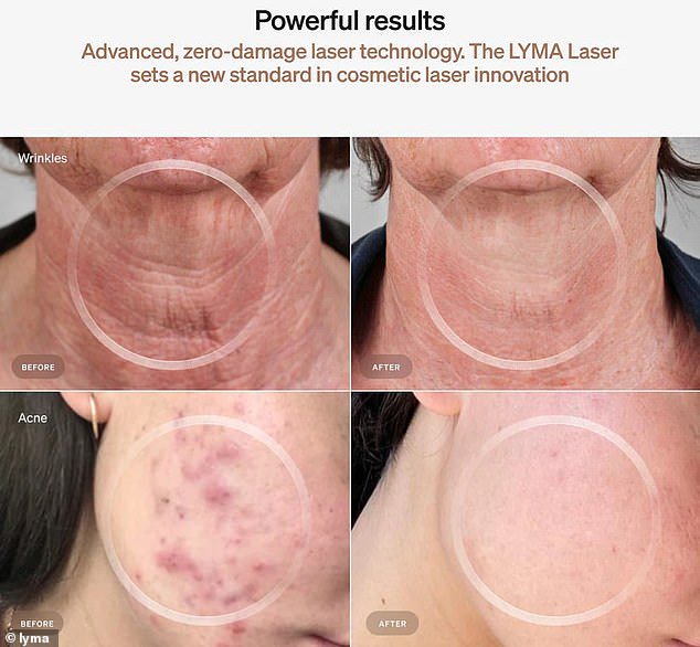 From deep creases in the neck to acne scarring, the LYMA Laser works incredibly well in reversing damage to dramatically improve the appearance of skin