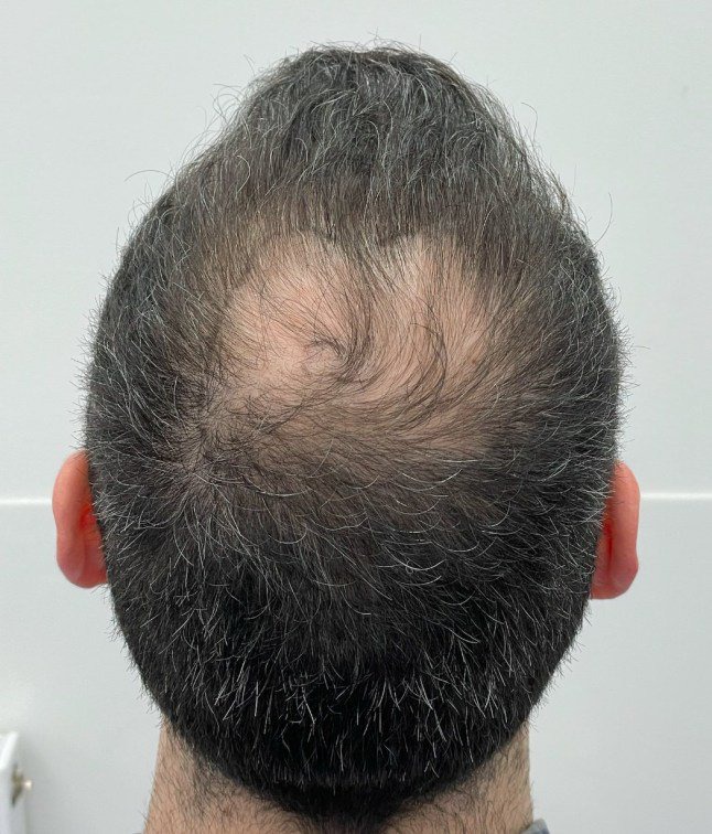 Hair transplant