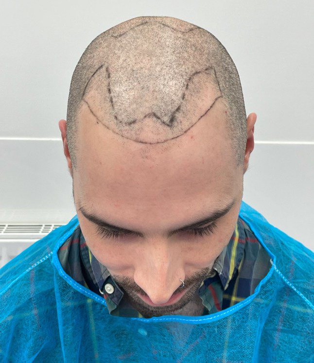 Hair transplant