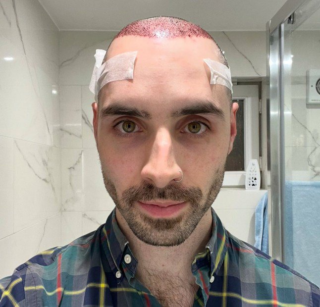 Hair transplant