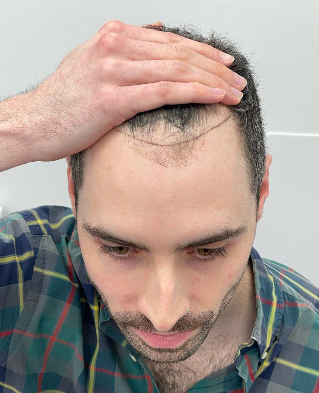 Hair transplant