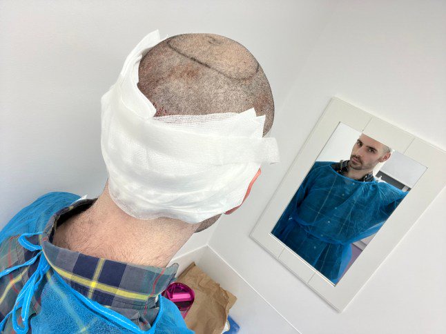 Hair transplant